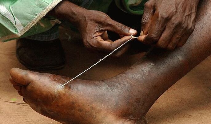 Extraction of subcutaneous parasite from the foot.