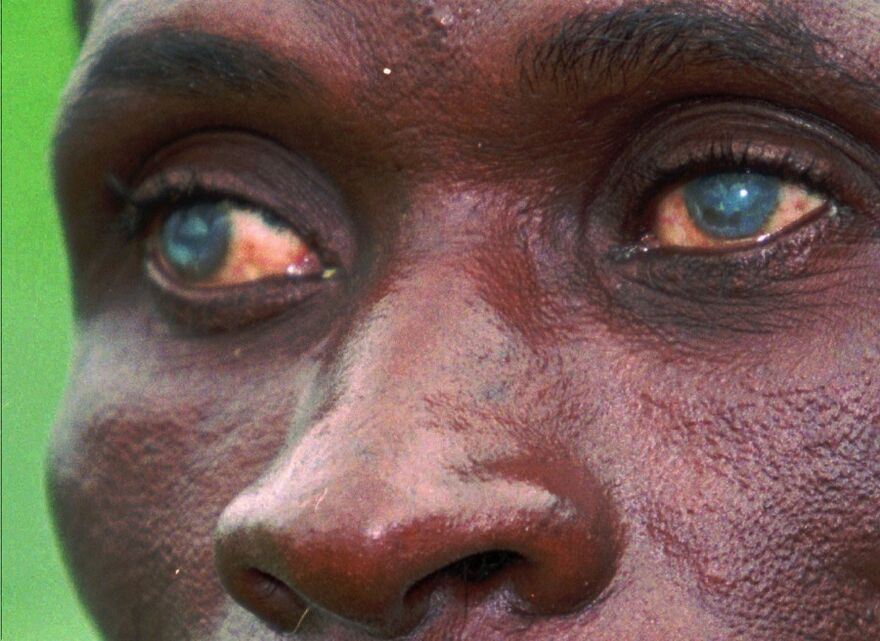parasites in human eyes