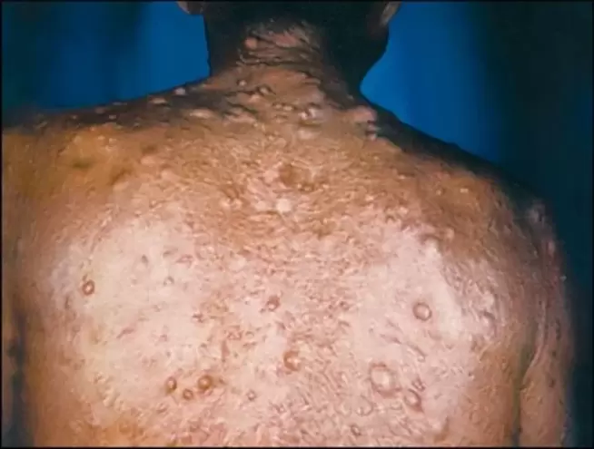 purulent nodes on the skin due to parasites